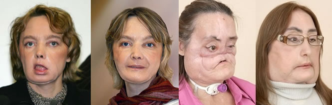 transplantes de rostro